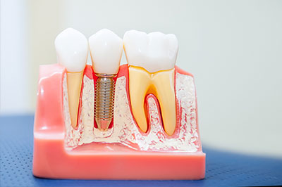 Wayne Valley Family Dentistry | Implant Dentistry, Extractions and Teeth Whitening
