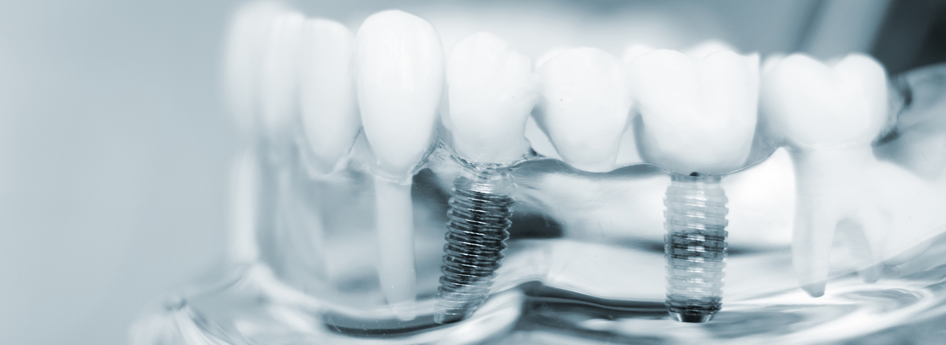 Wayne Valley Family Dentistry | Implant Dentistry, Dental Sealants and Dentures