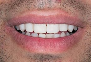 Wayne Valley Family Dentistry | Cosmetic Dentistry, Night Guards and Veneers