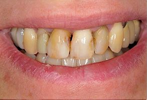 Wayne Valley Family Dentistry | Extractions, Teeth Whitening and Implant Dentistry